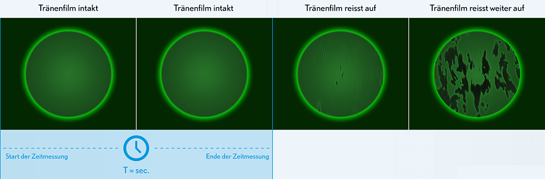 Sicca | Tränenfilmaufreißzeit